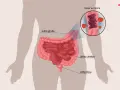 Ilustracja układu pokarmowego z zaznaczonym jelitem grubym, cienkim i odbytnicą. Powiększony fragment pokazuje krew w stolcu, co oznacza dodatni wynik badania na krew utajoną.