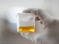 Ręka w białej rękawiczce trzyma pojemnik z żółtym płynem, badanie na obecność urobilinogen w moczu.