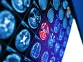 Sekwencja obrazów neurotop z wyróżnionym czerwonym obszarem mózgu, sugerującym nieprawidłowość.