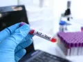 Ręka w niebieskiej rękawiczce trzyma probówkę z krwią oznaczoną "ALT - Test". W tle mikroskop i stojak z próbkami. To badanie ALT.