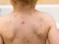 Plecy dziecka pokryte licznymi czerwonymi krostkami, które mogą być początkiem blizn po ospie.