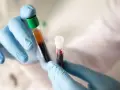 Ręce w niebieskich rękawiczkach trzymają probówki z krwią. Jedna probówka, z zieloną zakrętką, zawiera płyn o barwie bursztynowej i ciemnej. Druga, z białą zakrętką, wypełniona jest ciemnoczerwonym płynem. To próbki do badań, być może dla pacjentów z *...