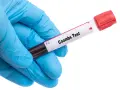 Rękawiczka medyczna trzyma probówkę z krwią do badania. Na etykiecie widnieje napis "Coombs Test", wskazujący na wykonanie odczynu Coombsa.