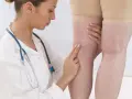 Lekarka bada nogi pacjentki z widocznymi żylakami. D-dimery mogą być badane w diagnostyce zakrzepicy.