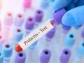 Ręka w niebieskiej rękawiczce trzyma probówkę z napisem "Prolactin - Test". Kiedy badać prolaktynę? To pytanie często zadawane przez pacjentów.