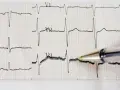 Zapis EKG z widocznym częstoskurczem nadkomorowym. Długopis wskazuje na fragment zapisu.