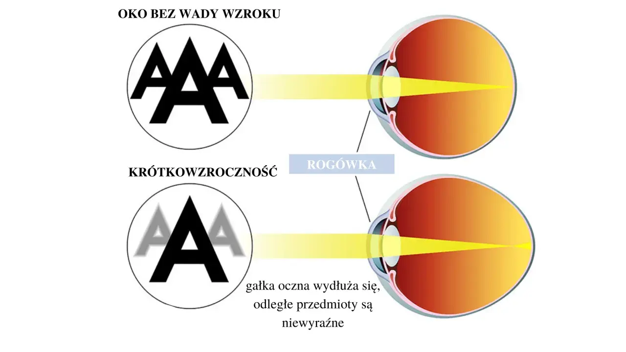 Budowa oka: zdrowe oko skupia światło na siatkówce, oko krótkowzroczne ma wydłużoną gałkę, przez co obraz jest nieostry.
