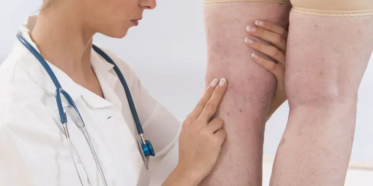 Lekarka bada nogi pacjentki z widocznymi żylakami. D-dimery mogą być badane w diagnostyce zakrzepicy.