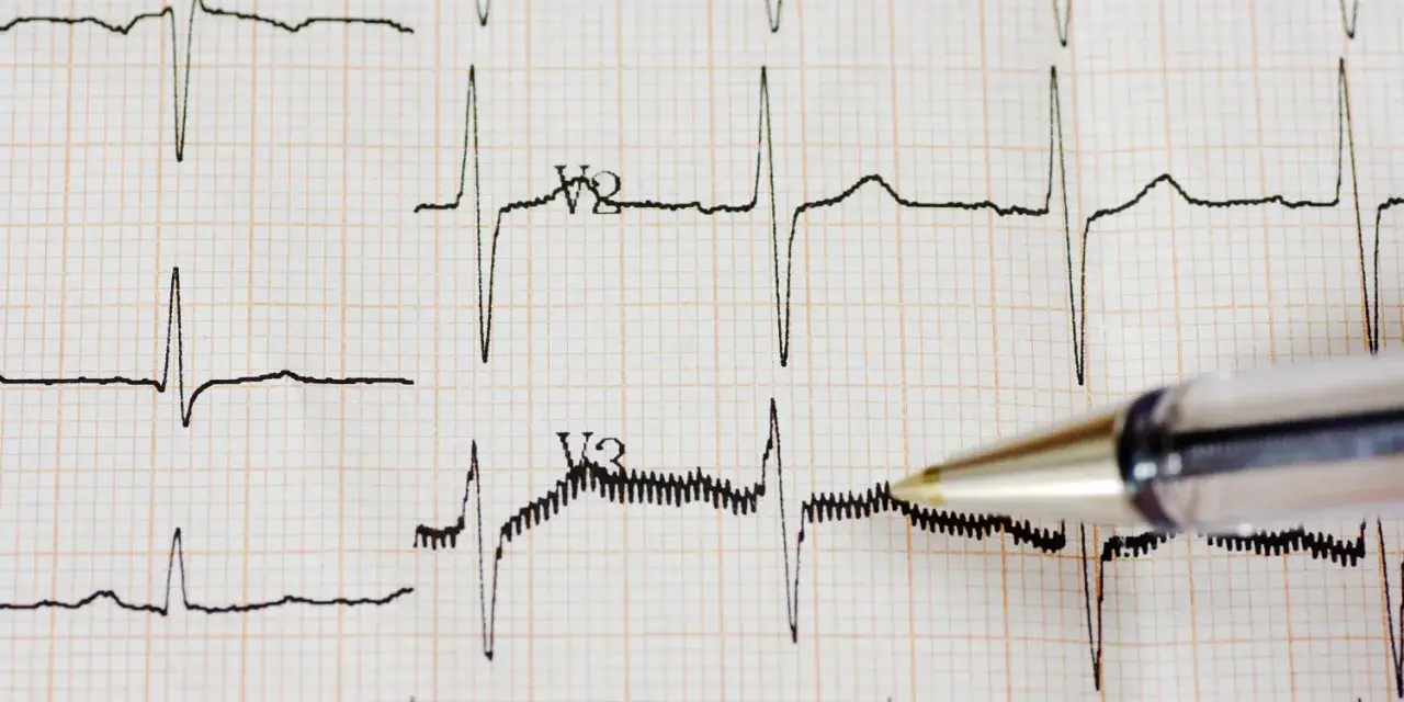 Zapis EKG z widocznym częstoskurczem nadkomorowym. Długopis wskazuje na fragment zapisu.