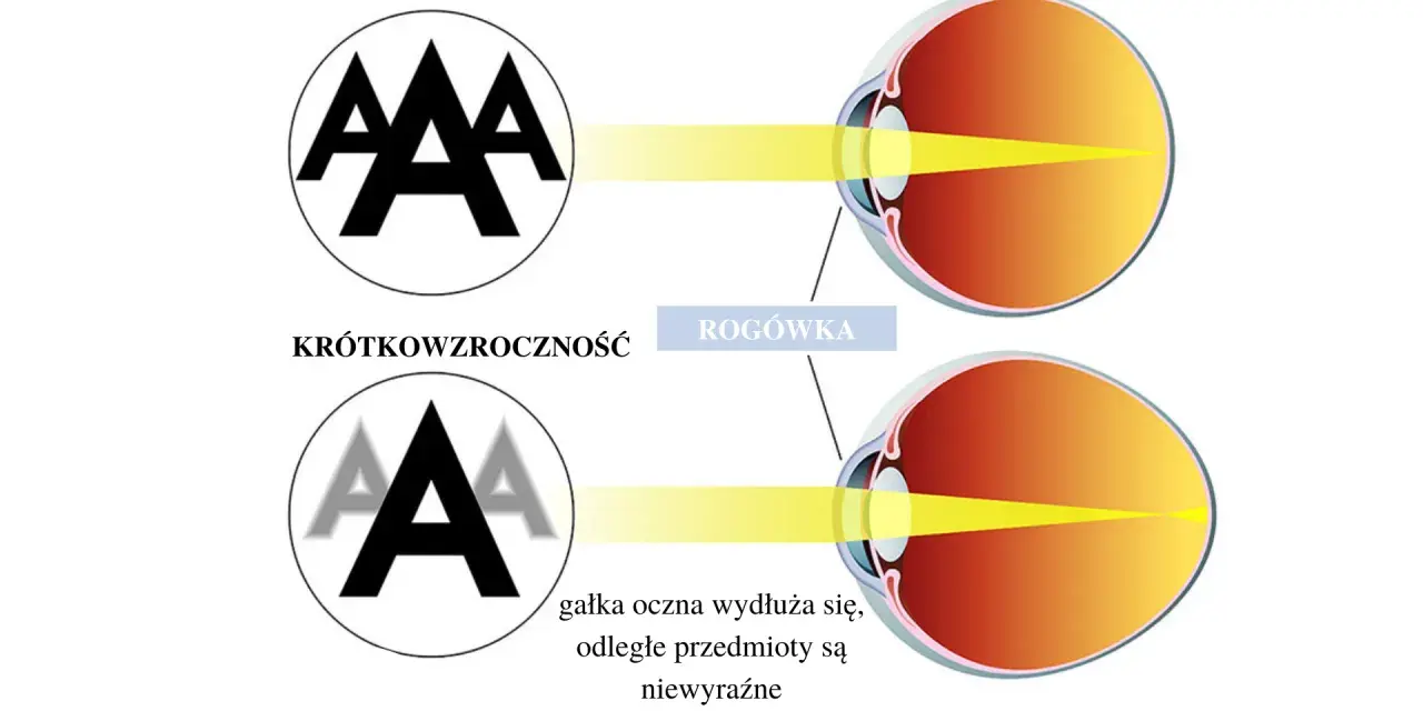 Budowa oka: zdrowe oko skupia światło na siatkówce, oko krótkowzroczne ma wydłużoną gałkę, przez co obraz jest nieostry.