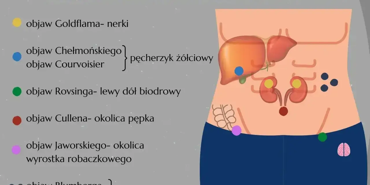 Objaw Jaworskiego lokalizuje się w okolicy wyrostka robaczkowego. Ilustracja pokazuje różne objawy brzuszne.