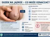 Guzek na jądrze, który może oznaczać różne rzeczy, od łagodnych zmian po nowotwór. Ból lub uczucie ciężkości w mosznie to jeden z objawów.
