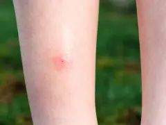 Czerwona, swędząca plamka na skórze nogi, będąca efektem ugryzienia meszki.