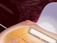 Ilustracja przedstawia biopsję mammotomiczną piersi z użyciem sondy ultradźwiękowej i igły.