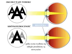 Budowa oka: zdrowe oko skupia światło na siatkówce, oko krótkowzroczne ma wydłużoną gałkę, przez co obraz jest nieostry.