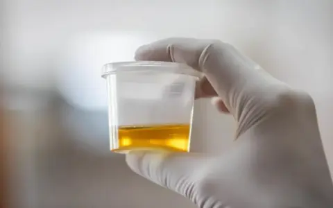 Ręka w białej rękawiczce trzyma pojemnik z żółtym płynem, badanie na obecność urobilinogen w moczu.