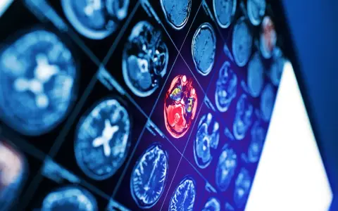 Sekwencja obrazów neurotop z wyróżnionym czerwonym obszarem mózgu, sugerującym nieprawidłowość.