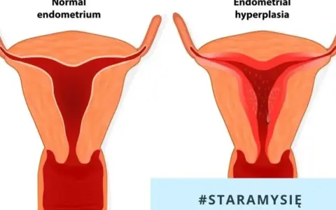 Porównanie prawidłowego endometrium z jego przerostem. Po lewej zdrowa macica, po prawej przerost endometrium.