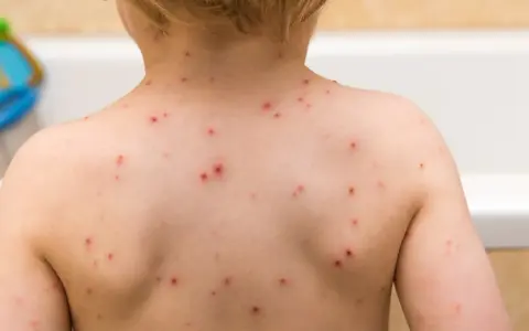 Plecy dziecka pokryte licznymi czerwonymi krostkami, które mogą być początkiem blizn po ospie.