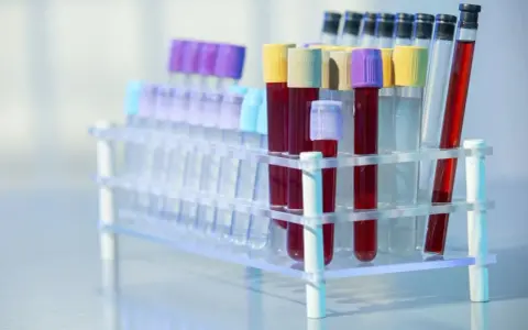 Rurki z krwią w stojaku laboratoryjnym. Czy to badanie CA 125?