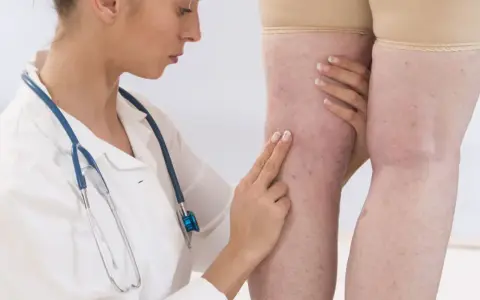 Lekarka bada nogi pacjentki z widocznymi żylakami. D-dimery mogą być badane w diagnostyce zakrzepicy.