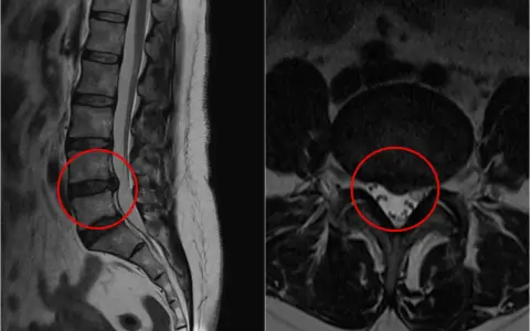 Obraz MRI kręgosłupa lędźwiowego z widoczną protruzją krążka międzykręgowego, zaznaczoną na czerwono.