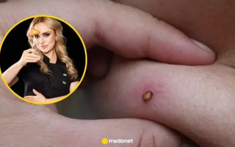 Kobieta z młoteczkiem neurologicznym i rana na skórze, która może być objawem neuroboreliozy.
