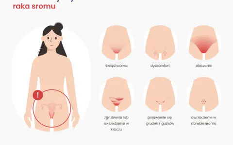 Wczesne objawy raka sromu: świąd, pieczenie, dyskomfort, zgrubienia, grudki, owrzodzenia. Zwróć uwagę na zmiany.