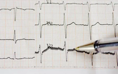 Zapis EKG z widocznym częstoskurczem nadkomorowym. Długopis wskazuje na fragment zapisu.
