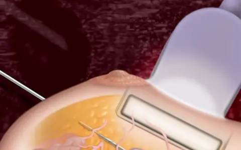 Ilustracja przedstawia biopsję mammotomiczną piersi z użyciem sondy ultradźwiękowej i igły.