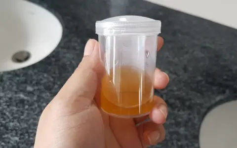 Próbka moczu z widocznymi fosforanami bezpostaciowymi.