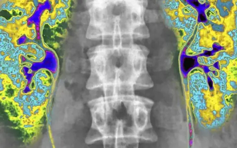 Kolorowa scyntygrafia kości pokazuje kręgosłup i obszary o zwiększonej aktywności metabolicznej, sugerujące potencjalne problemy.