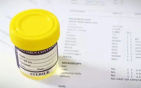 Pojemnik na mocz i wyniki analizy, gdzie widoczny jest parametr bilirubina w moczu.