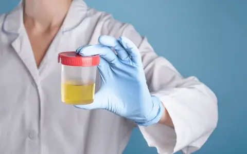 Ręka w niebieskiej rękawiczce trzyma pojemnik z żółtym moczem, w którym mogą być obecne nabłonki płaskie.