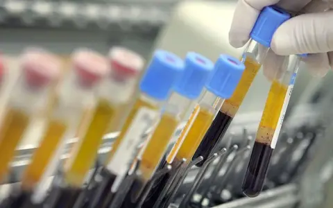 Rękawiczka pobiera probówkę z ciemną krwią i żółtym osoczem. To cea co to za badanie?