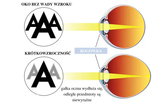 Budowa oka: zdrowe oko skupia światło na siatkówce, oko krótkowzroczne ma wydłużoną gałkę, przez co obraz jest nieostry.