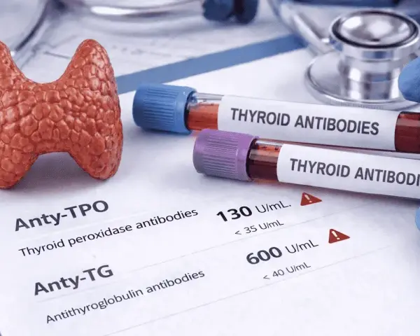 Model tarczycy obok probówek z napisem "THYROID ANTIBODIES" i wynikiem badania anty-TPO.