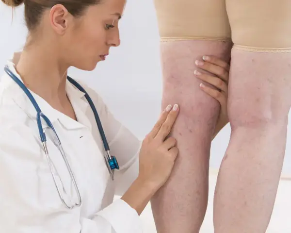 Lekarka bada nogi pacjentki z widocznymi żylakami. D-dimery mogą być badane w diagnostyce zakrzepicy.