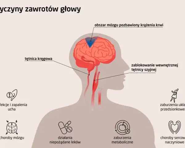 Ilustracja przedstawia przyczyny zawrotów głowy: zablokowanie tętnicy szyjnej, infekcje ucha, choroby mózgu, zaburzenia metaboliczne i sercowo-naczyniowe.
