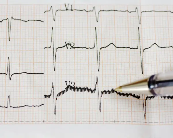 Zapis EKG z widocznym częstoskurczem nadkomorowym. Długopis wskazuje na fragment zapisu.