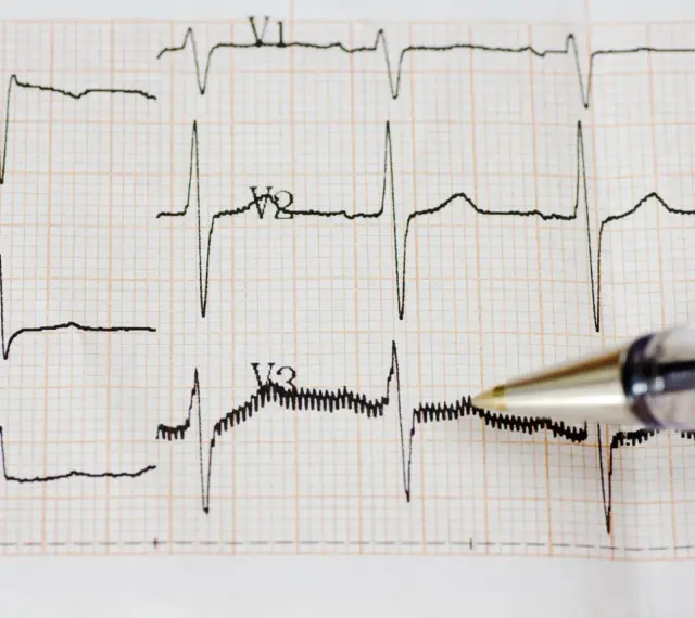 Zapis EKG z widocznym częstoskurczem nadkomorowym. Długopis wskazuje na fragment zapisu.