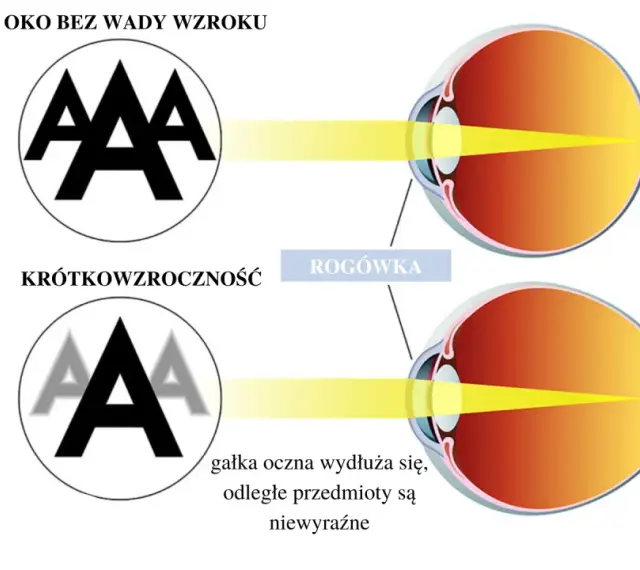 Budowa oka: zdrowe oko skupia światło na siatkówce, oko krótkowzroczne ma wydłużoną gałkę, przez co obraz jest nieostry.