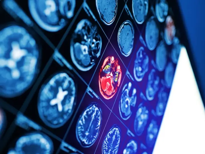 Sekwencja obrazów neurotop z wyróżnionym czerwonym obszarem mózgu, sugerującym nieprawidłowość.