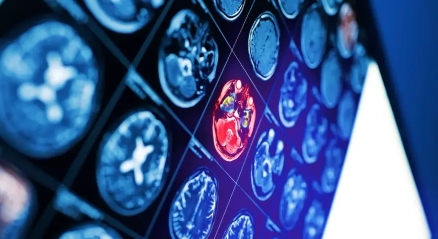 Sekwencja obrazów neurotop z wyróżnionym czerwonym obszarem mózgu, sugerującym nieprawidłowość.