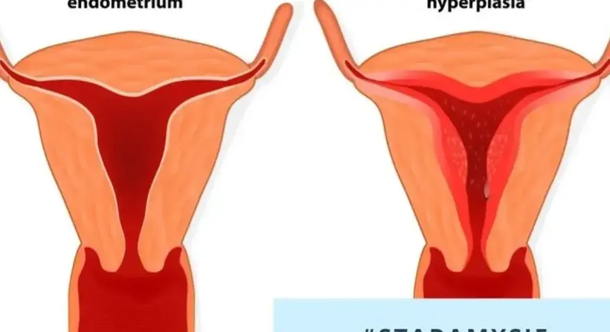 Porównanie prawidłowego endometrium z jego przerostem. Po lewej zdrowa macica, po prawej przerost endometrium.