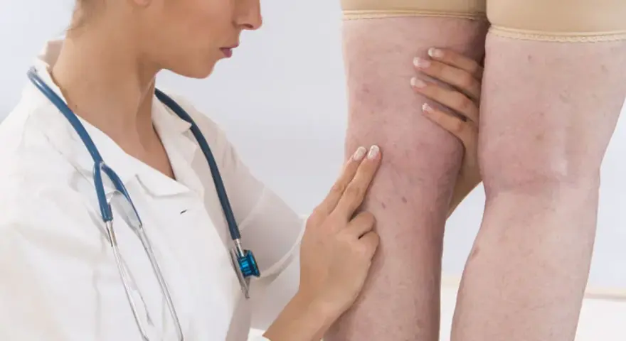Lekarka bada nogi pacjentki z widocznymi żylakami. D-dimery mogą być badane w diagnostyce zakrzepicy.