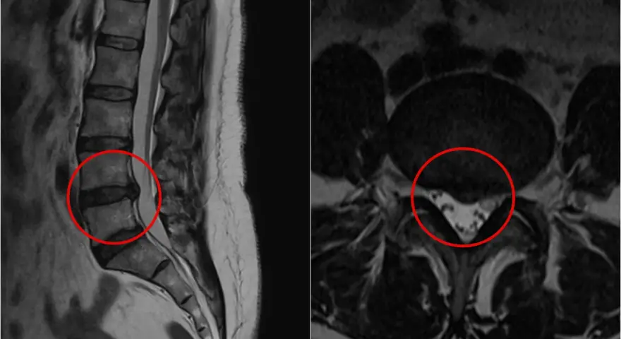 Obraz MRI kręgosłupa lędźwiowego z widoczną protruzją krążka międzykręgowego, zaznaczoną na czerwono.