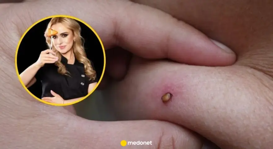 Kobieta z młoteczkiem neurologicznym i rana na skórze, która może być objawem neuroboreliozy.