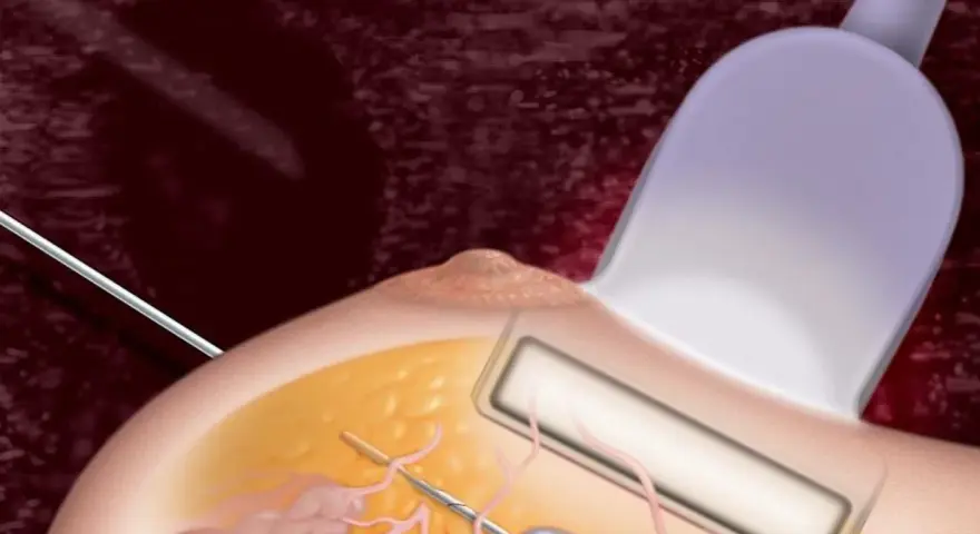 Ilustracja przedstawia biopsję mammotomiczną piersi z użyciem sondy ultradźwiękowej i igły.