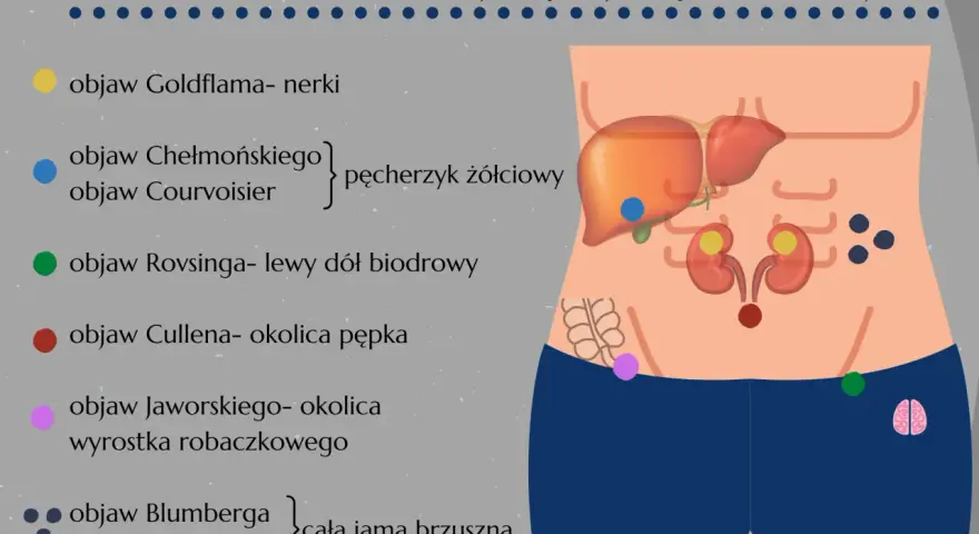 Objaw Rovsinga zaznaczony zieloną kropką w lewym dole biodrowym, ilustrujący objawy z jamy brzusznej.